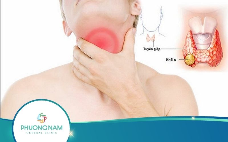 U Tuyến Giáp – Tình Trạng Nguy Hiểm Không Được Chủ Quan
