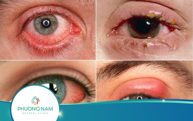 Viêm Kết Mạc, Viêm Kết Mạc Dị Ứng – Nguyên Nhân, Triệu Chứng, Cách Khắc Phục