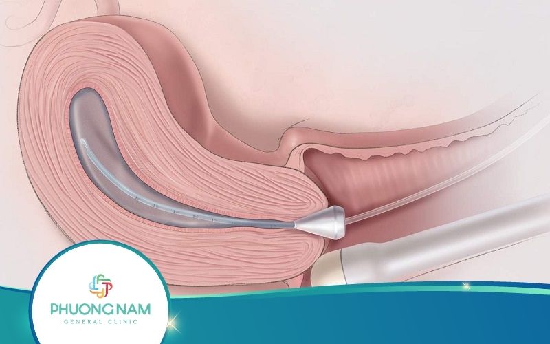 Kinh Nghiệm Siêu Âm Đầu Dò Bạn Nhất Định Phải Biết