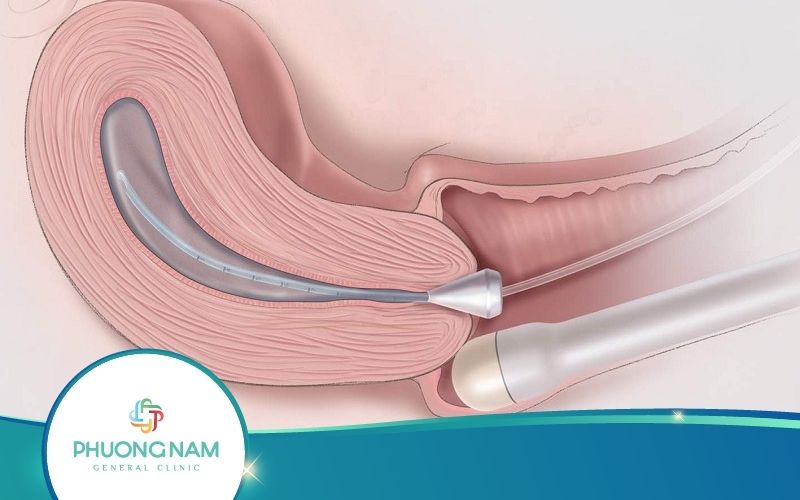 [Bạn Phải Biết] Siêu Âm Đầu Dò Có Hại Không?