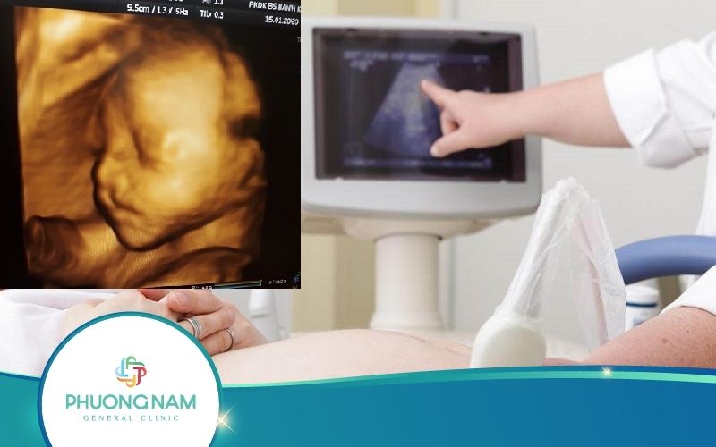 Siêu Âm Thai Bị Sứt Môi Thì Phải Làm Sao?