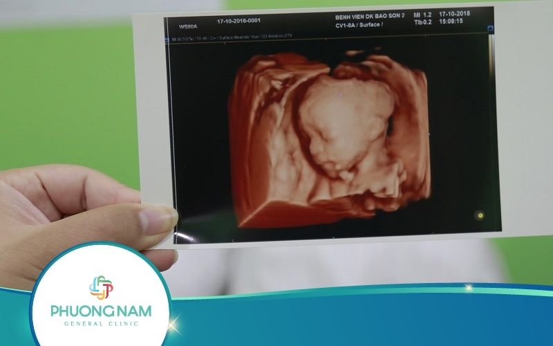 Siêu Âm Thai Màu Là Gì? Ưu, Nhược Điểm Ra Sao?
