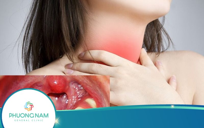 U Cứng Trên Vòm Họng – Dấu Hiệu Của Nhiều Bệnh Lý Nguy Hiểm