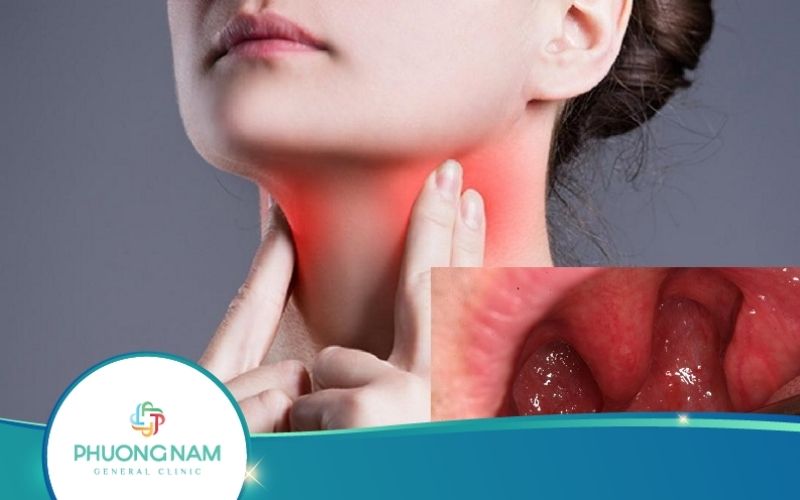 Ung Thư Vòm Họng – Nguyên Nhân Và Cách Nhận Biết