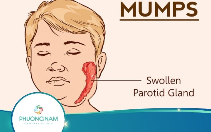 Bệnh Quai Bị Bao Lâu Thì Khỏi Và Cách Nhất Biết Thế Nào?