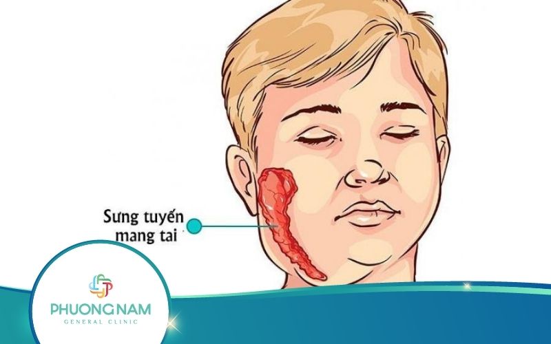 [Giải Đáp] Bệnh Quai Bị Có Bị Lại Lần 2 Không?