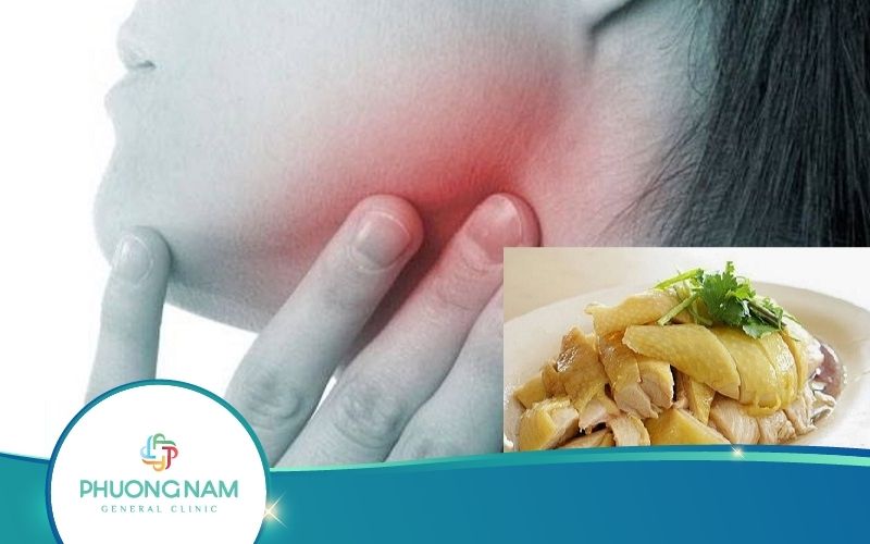 [Giải Đáp Từ Chuyên Gia] Bị Quai Bị Có Ăn Được Thịt Gà Không?