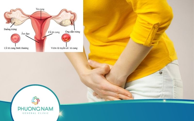 Viêm Lộ Tuyến Tử Cung – Bệnh Lý Nguy Hiểm Cần Hết Sức Lưu Ý