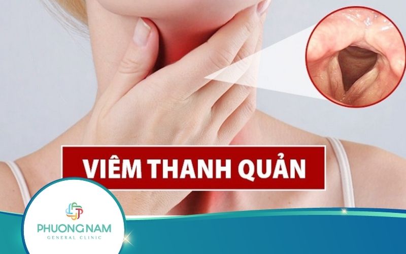 Viêm Thanh Quản: Nguyên Nhân, Triệu Chứng, Cách Điều Trị
