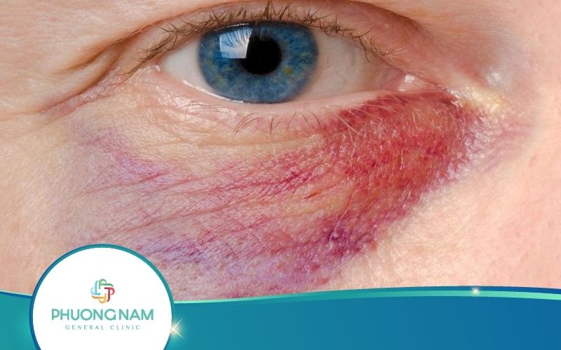 Cách Che Vết Bầm Tím Ở Mắt Cực Hay – Nhất Định Phải Biết
