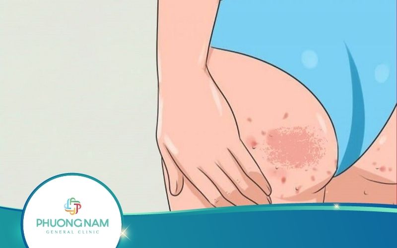 Top 10 Cách Trị Thâm Mông Tại Nhà Hiệu Quả Nhất