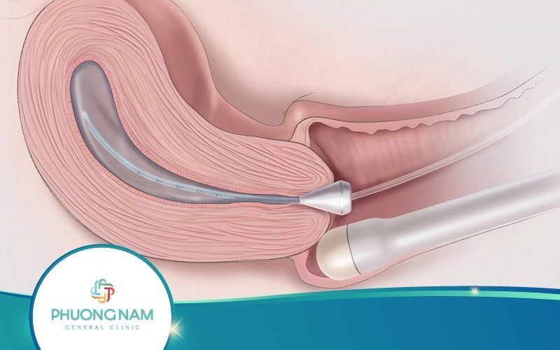 Siêu Âm Đầu Dò Bao Nhiêu Tiền? Khi Nào Cần Siêu Âm Đầu Dò?