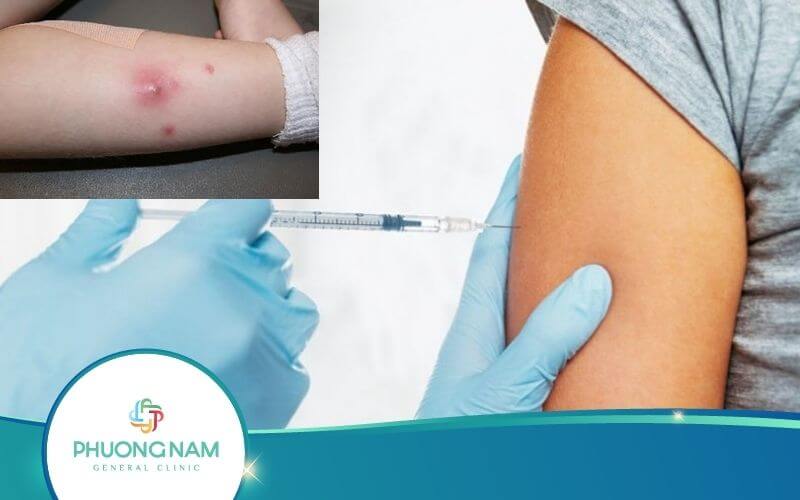 Các Tai Biến Tiêm Bắp Có Thể Gặp Phải