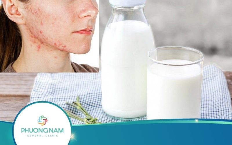 Cách Trị Dị Ứng Da Mặt Bằng Sữa Tươi – Ai Cũng Cần Biết