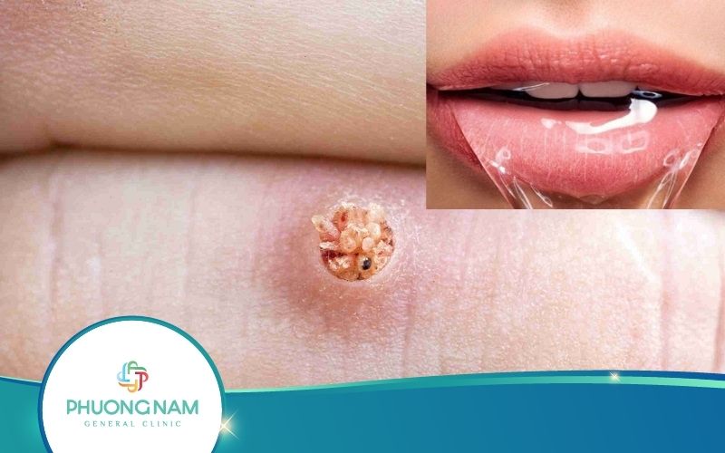 【Giải Đáp】Trị Mụn Cóc Bằng Nước Miếng – Thực Hư Ra Sao?