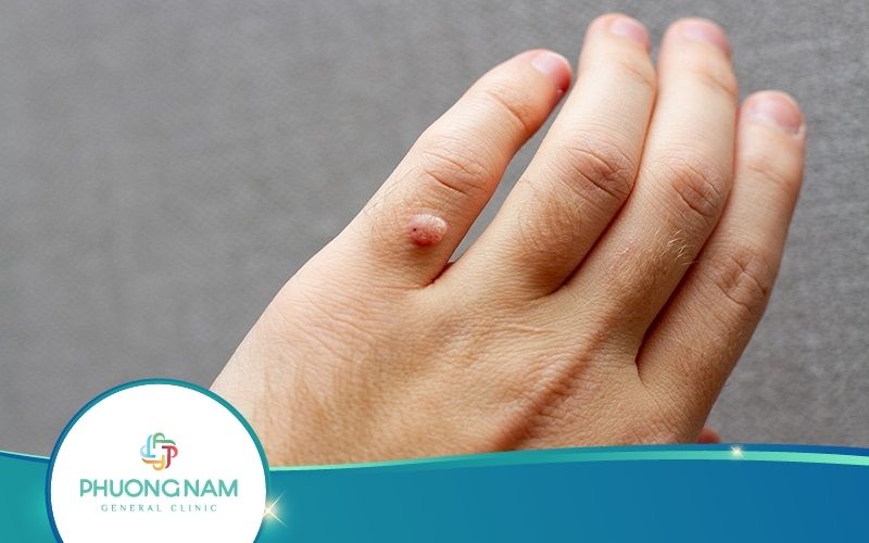 Trị Mụn Cóc Bằng Nước Muối Có Hiệu Quả Như Lời Đồn?