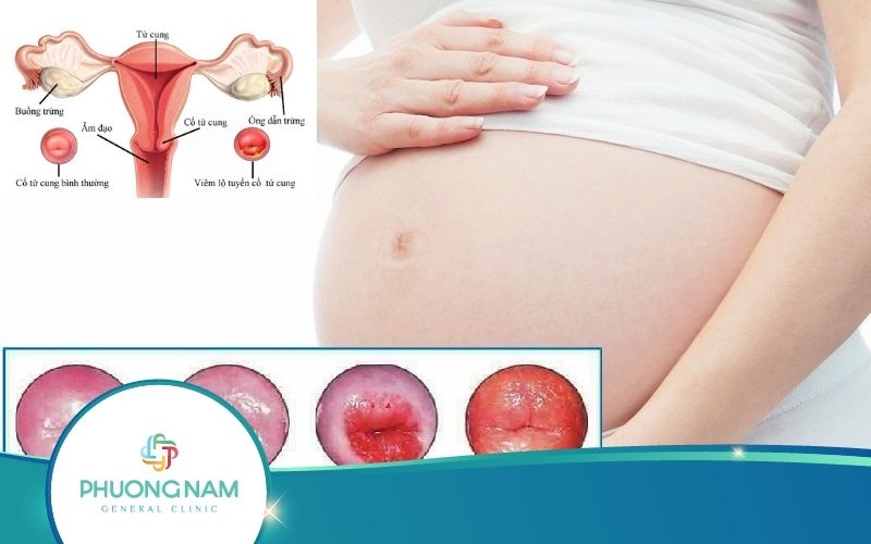 Viêm Lộ Tuyến Có Ảnh Hưởng Đến Thai Nhi Không?