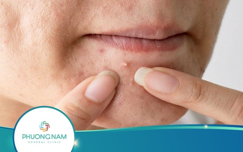 Cách Chữa Mụn Nhọt Sưng To Cực Hay – Ai Cũng Nên Biết