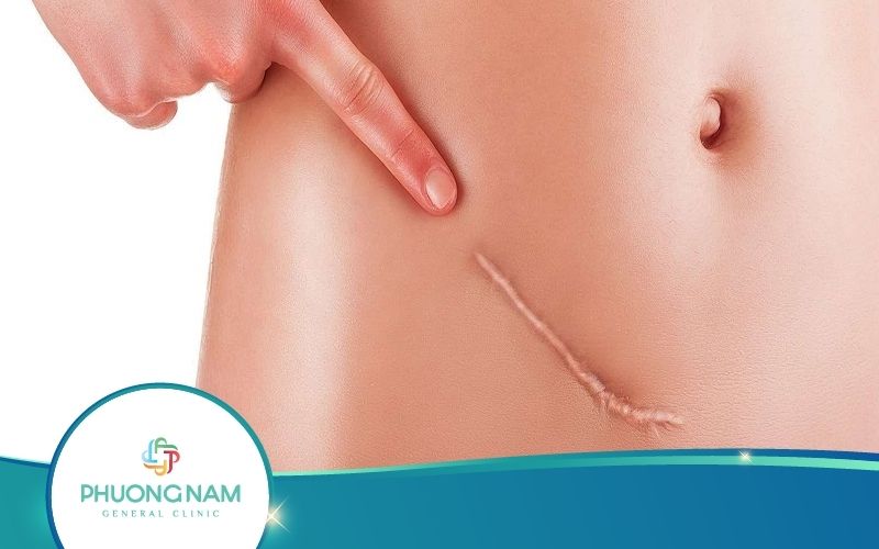 Top 3 Cách Làm Mờ Sẹo Sau Phẫu Thuật Hay Nhất