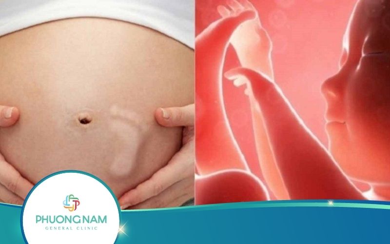 Thai Nhi Đạp Nhói Bụng Dưới Có Nguy Hiểm Không?