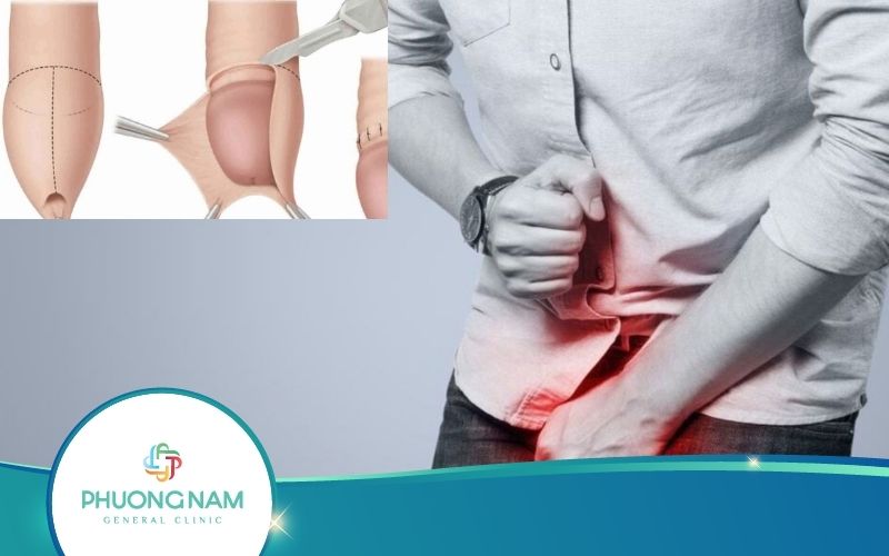 Biến Chứng Sau Khi Cắt Bao Quy Đầu Và Cách Xử Lý Hiệu Quả