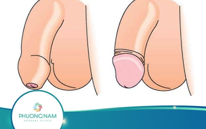 Các Phương Pháp Cắt Bao Quy Đầu Tốt Nhất Hiện Nay
