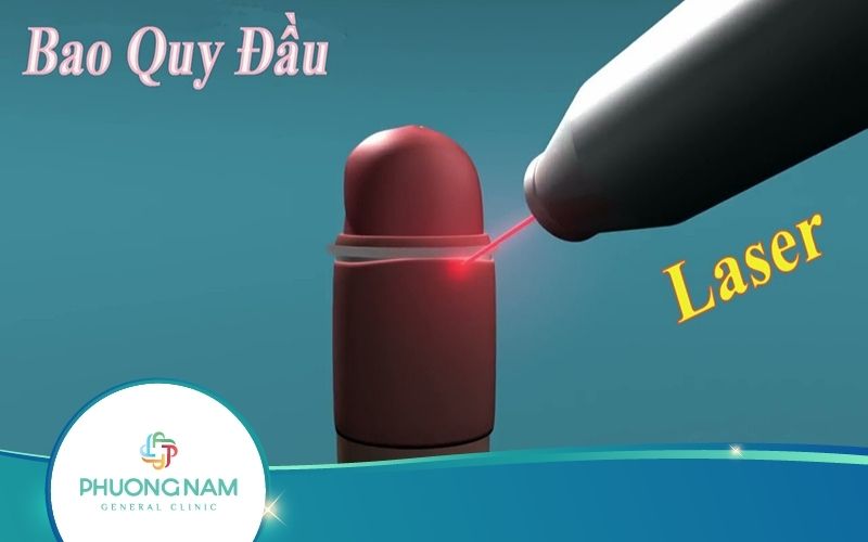 Cắt Bao Quy Đầu Bằng Laser – Thông Tin Từ A Đến Z