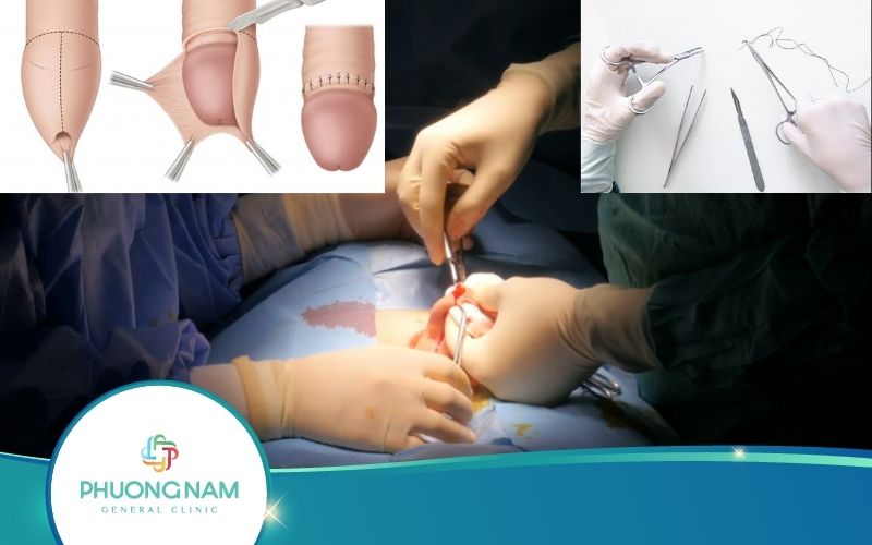 Cắt Bao Quy Đầu Bao Lâu Thì Tiêu Hết Chỉ? – Giải Đáp Chi Tiết