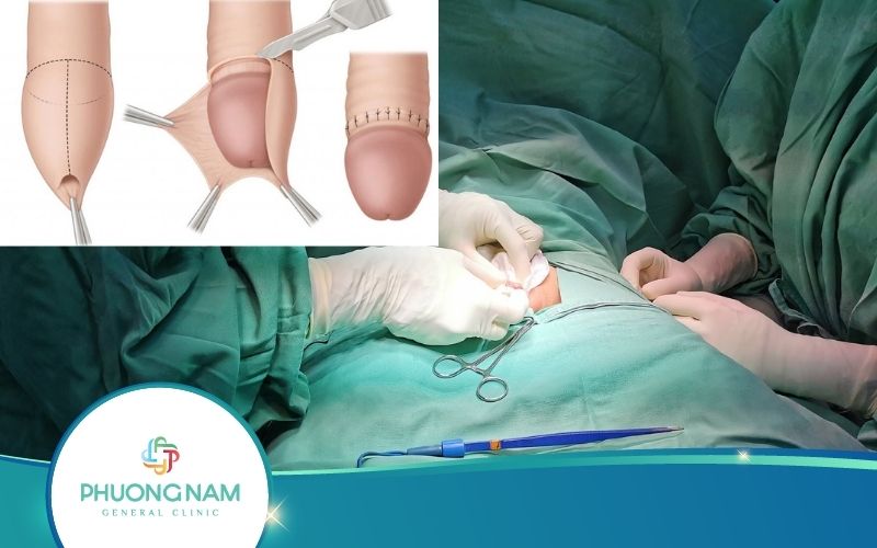Cắt Bao Quy Đầu Có Để Lại Sẹo Không? – Bác Sĩ Giải Đáp