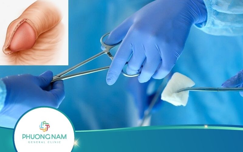 Cắt Bao Quy Đầu Truyền Thống Có Phải Là Cách Tối Ưu?
