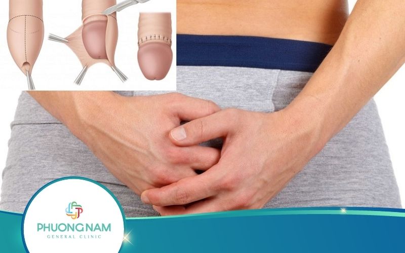 Phù Nề Sau Khi Cắt Bao Quy Đầu Có Nguy Hiểm Không? Bao Lâu Thì Khỏi