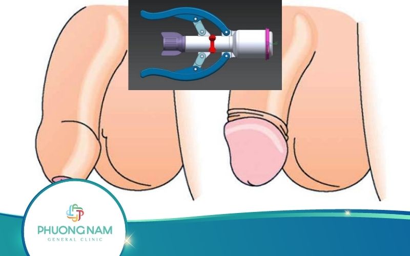 Review Cắt Bao Quy Đầu Bằng Máy Surkon Bạn Nên Biết!