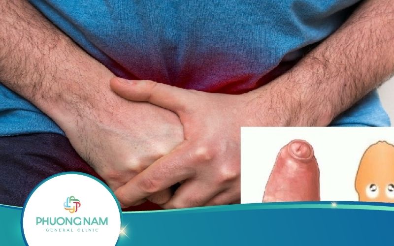 Bán Hẹp Bao Quy Đầu – Dấu Hiệu Và Cách Khắc Phục