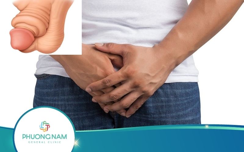 Bao Quy Đầu Bị Sưng Phồng Lên Như Cục Mỡ Có Ảnh Hưởng Gì?