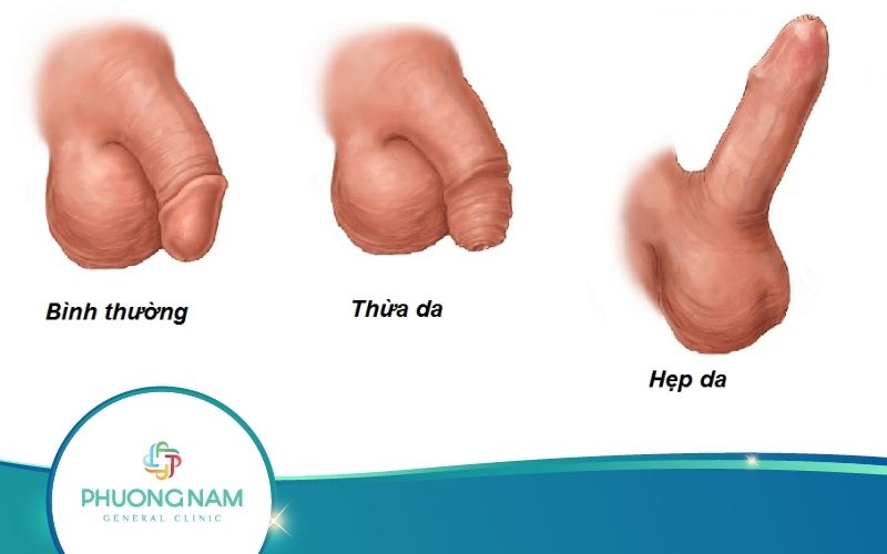 [Giải Đáp] Bao Quy Đầu Bình Thường Là Như Thế Nào?