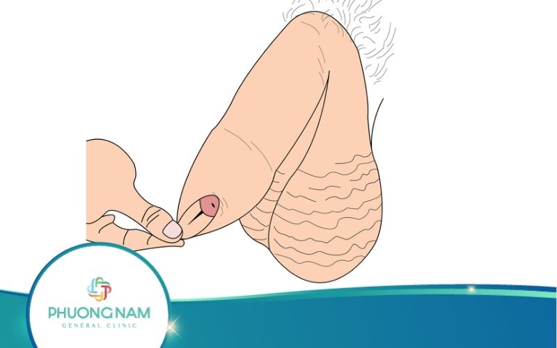 Bao Quy Đầu Dài Và Những Điều Phái Mạnh Nên Biết