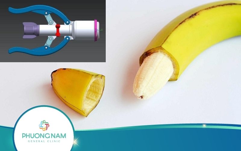 [Thực Hư] Cắt Bao Quy Đầu Bằng Máy Điện Không Đau Không Chảy Máu