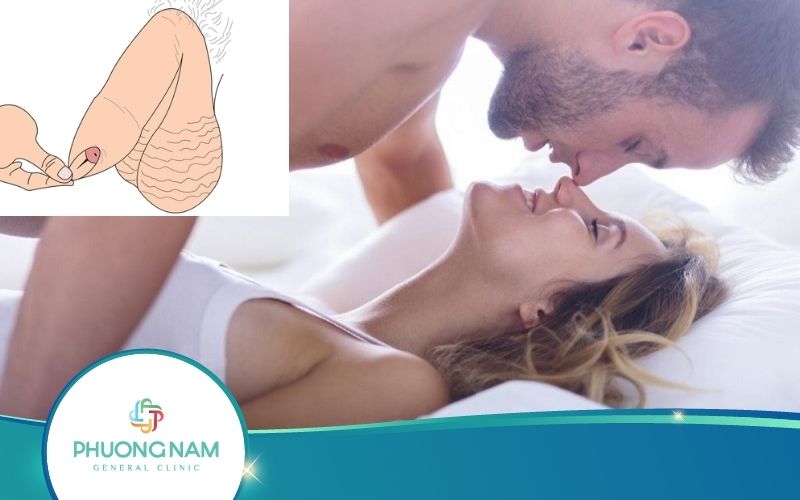 [Hỏi Đáp] Chưa Lột Bao Quy Đầu Quan Hệ Có Thai Không?