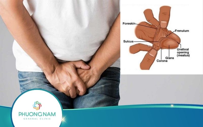 Lột Bao Quy Đầu Bị Đau Phải Xử Lý Như Thế Nào?