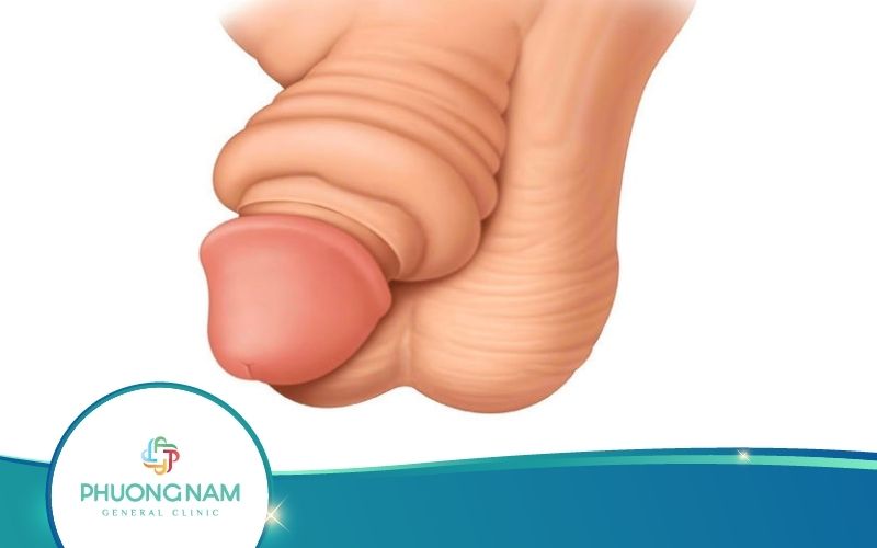 Sưng Bao Quy Đầu Nguyên Nhân Do Đâu? Có Nguy Hiểm Không?