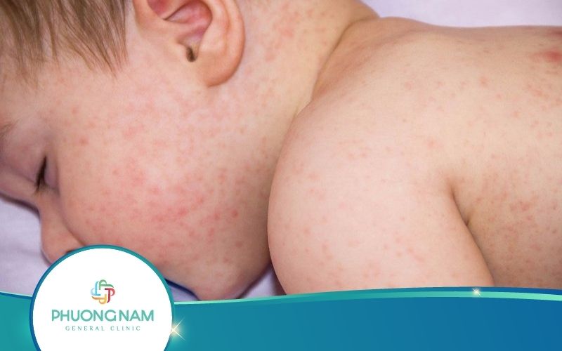 Sốt Phát Ban Có Lây Không? Điều Trị Cho Trẻ Tại Nhà Ra Sao?