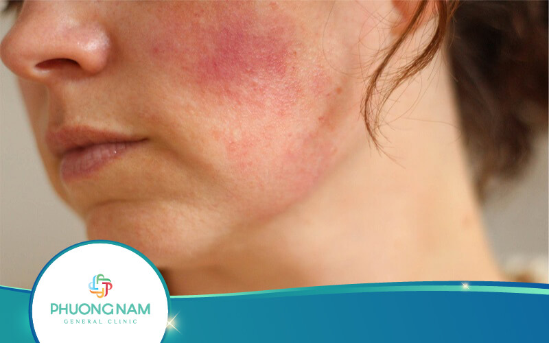 11+ Cách Thải Độc Da Nhiễm Corticoid Tại Nhà Hiệu Quả Nhất