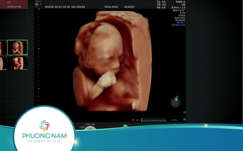 Hình Ảnh Siêu Âm 4D Theo Từng Giai Đoạn Phát Triển Của Thai Nhi