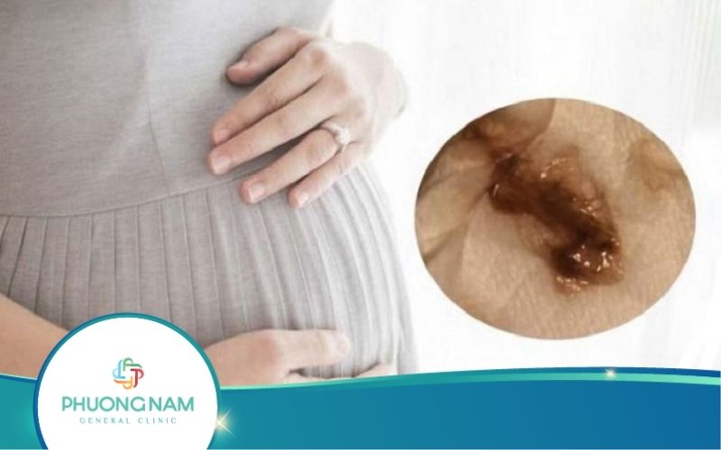 Mang Thai 3 Tháng Đầu Ra Dịch Màu Nâu Phải Làm Sao?