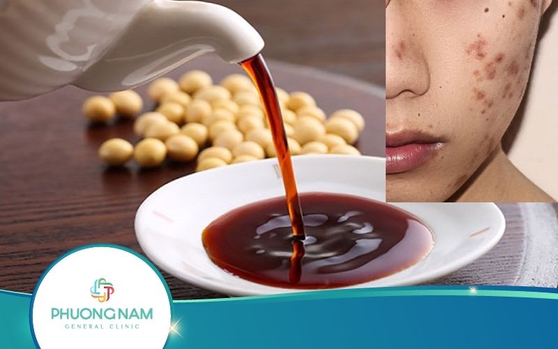 Ăn Nước Tương Có Bị Sẹo Thâm Không? Vì Sao?