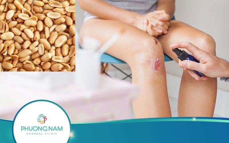 Bị Vết Thương Hở Có Được Ăn Đậu Phộng Không? Vì Sao?