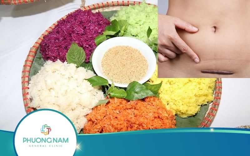 Sinh Mổ Kiêng Ăn Gì Để Không Bị Sẹo Lồi? Sản Phụ Nên Biết!