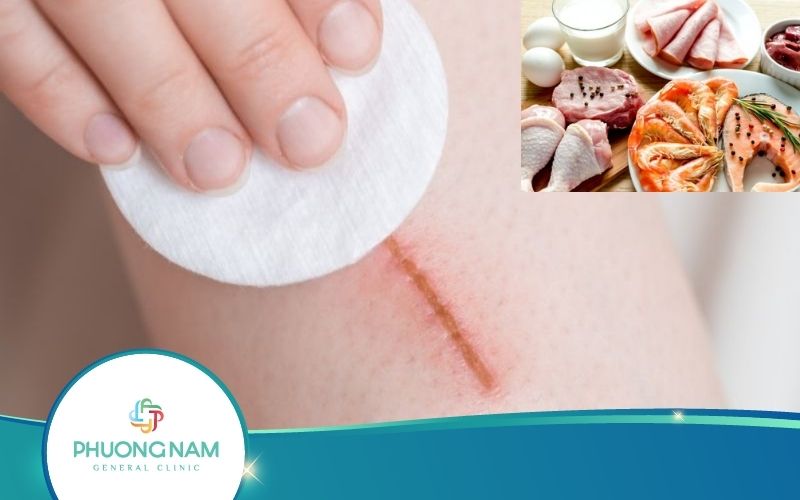 Thời Gian Ăn Kiêng Chống Sẹo Thâm Là Bao Lâu?