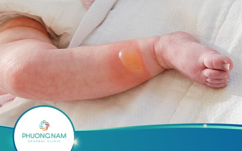 Trẻ Sơ Sinh Bị Phồng Rộp Da Mẹ Phải Làm Gì?