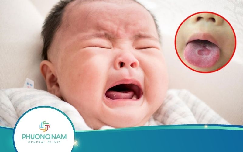 Trẻ Sơ Sinh Bị Trắng Lưỡi Nguyên Nhân Do Đâu? Trị Thế Nào?